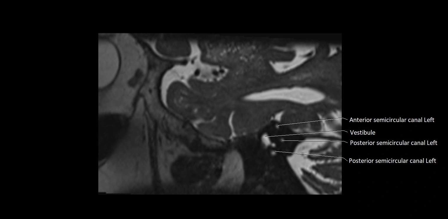 Cranial nerve sagittal anatomy MRI 3T image 5.webp